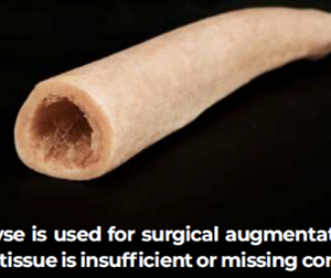 Femur diaphyse, frozen