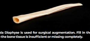 Fibula diaphyse, frozen